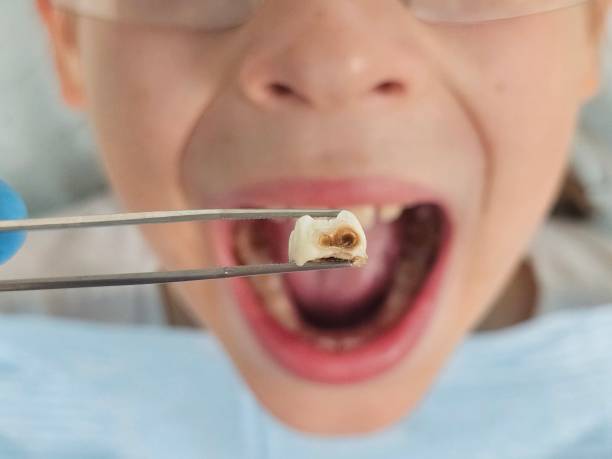 Best Emergency Treatment for Toothache in Minier, IL