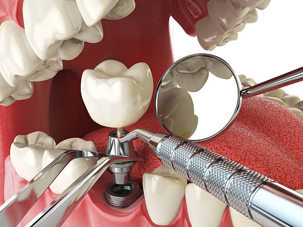 Best Emergency Root Canal Treatment in Minier, IL